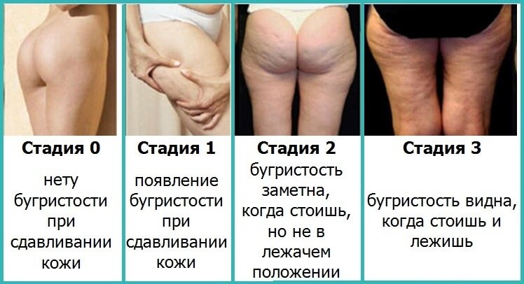 Как избавится от целлюлита Как избавится от целлюлита