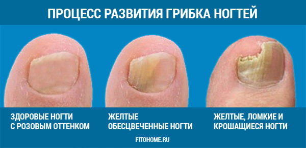 Лечение грибка ногтей на ногах Лечение грибка ногтей на ногах