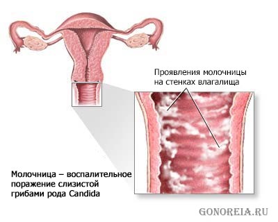 Признаки молочницы у женщин Признаки молочницы у женщин
