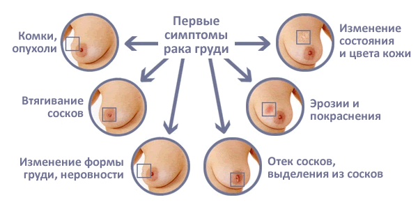 Рак грудной железы симптомы