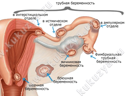 Внематочная беременность признаки Внематочная беременность признаки